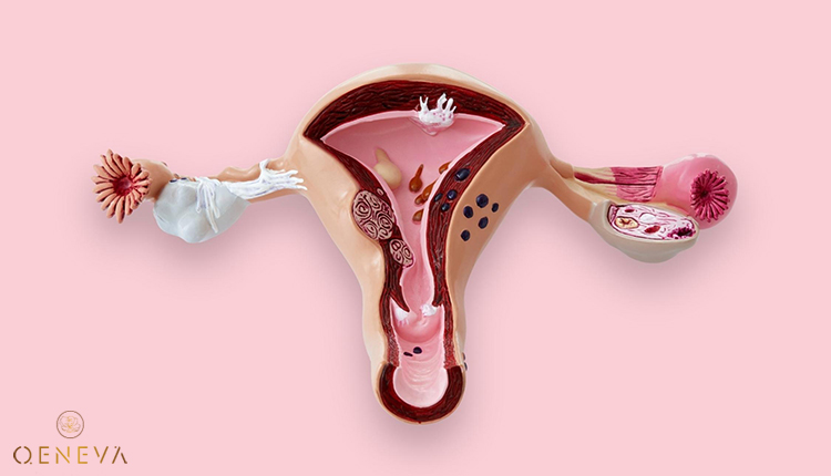 3.6. Hội chứng buồng trứng đa nang 1 3.6. Hội chứng buồng trứng đa nang 1