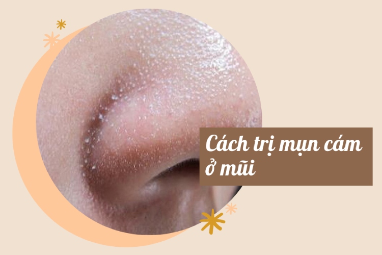 8 cách trị mụn cám ở mũi tại nhà - thực hư hiệu quả! 1 8 cách trị mụn cám ở mũi tại nhà - thực hư hiệu quả! 1