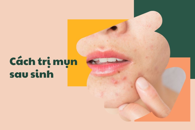 Hé lộ nguyên nhân và cách trị mụn sau sinh cho mẹ bỉm 1