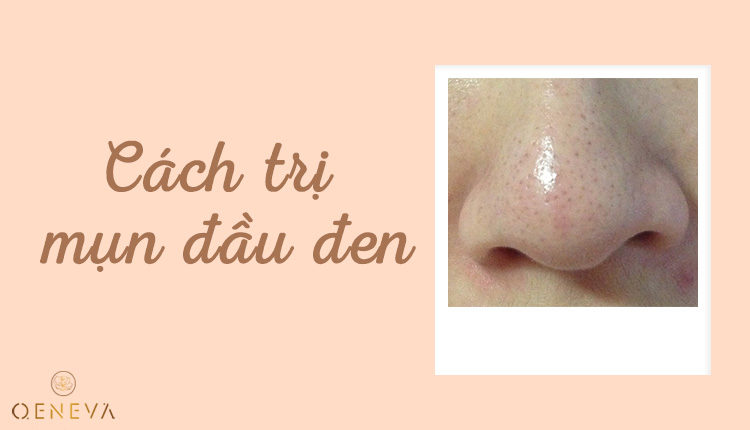 cach-tri-mun-dau-den