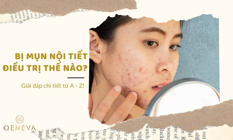 Cách trị mụn nội tiết: Giải đáp thông tin từ A đến Z! 1 Cách trị mụn nội tiết: Giải đáp thông tin từ A đến Z! 1