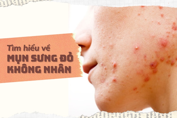 Tìm Hiểu Về Mụn Sưng đỏ Không Nhân Và Cách điều Trị Hiệu Quả 