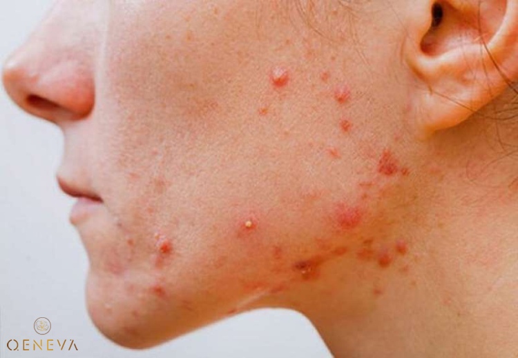 2. Nguyên nhân gây mụn sưng đỏ không nhân 1 2. Nguyên nhân gây mụn sưng đỏ không nhân 1