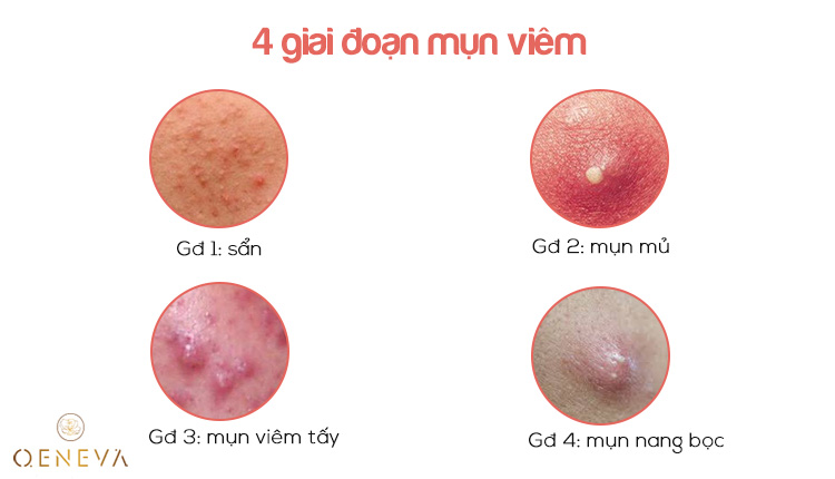 4. Phân loại mụn viêm 1 4. Phân loại mụn viêm 1