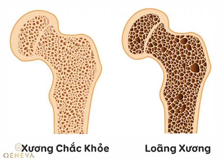 Ngăn ngừa loãng xương 1 Ngăn ngừa loãng xương 1