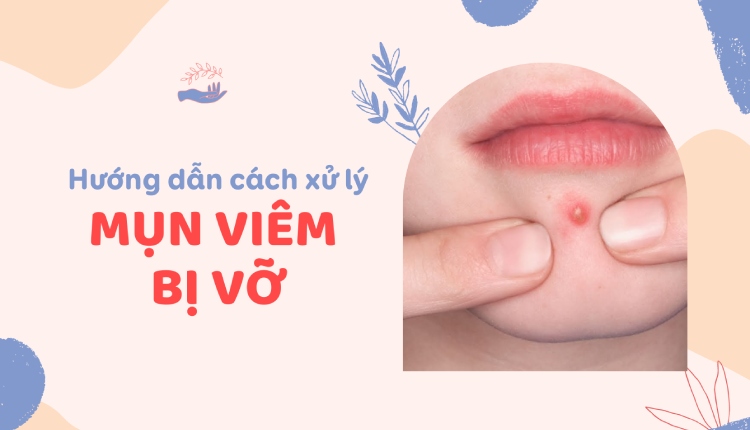 Tìm hiểu cách xử lý mụn viêm bị vỡ tại nhà đơn giản 1 Tìm hiểu cách xử lý mụn viêm bị vỡ tại nhà đơn giản 1