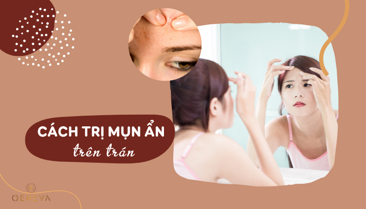 Cách trị mụn ẩn trên trán