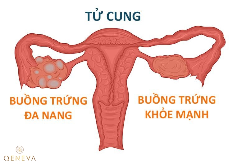 3.1. Hội chứng buồng trứng đa nang 1
