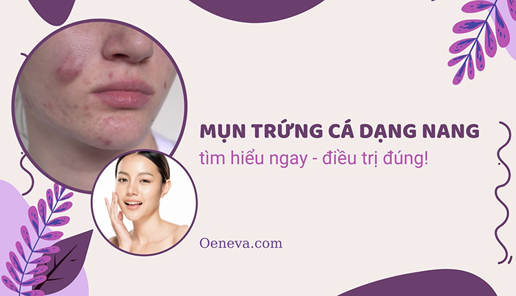 Mụn trứng cá dạng nang: Tìm hiểu nhanh - điều trị đúng! 1