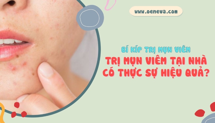 7 cách trị mụn viêm sai lầm tại nhà nhiều người hay áp dụng 1 7 cách trị mụn viêm sai lầm tại nhà nhiều người hay áp dụng 1