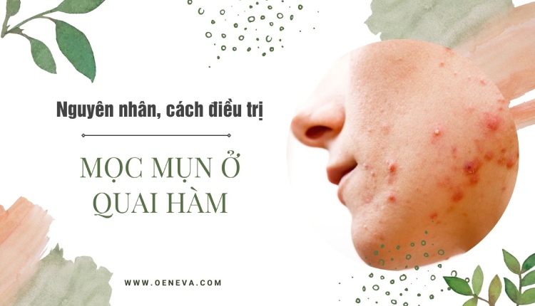 Tại sao mọc mụn ở quai hàm? Cách trị mụn quai hàm hiệu quả 1 Tại sao mọc mụn ở quai hàm? Cách trị mụn quai hàm hiệu quả 1