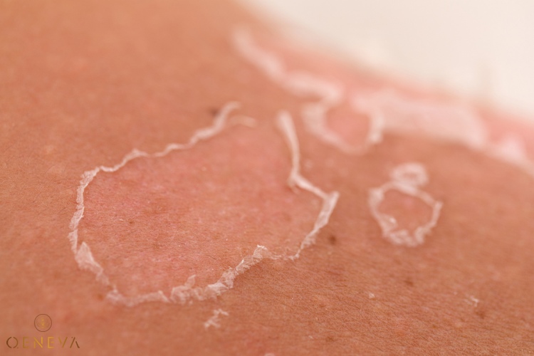 1. Dấu hiệu khi da chân bị cháy nắng 1