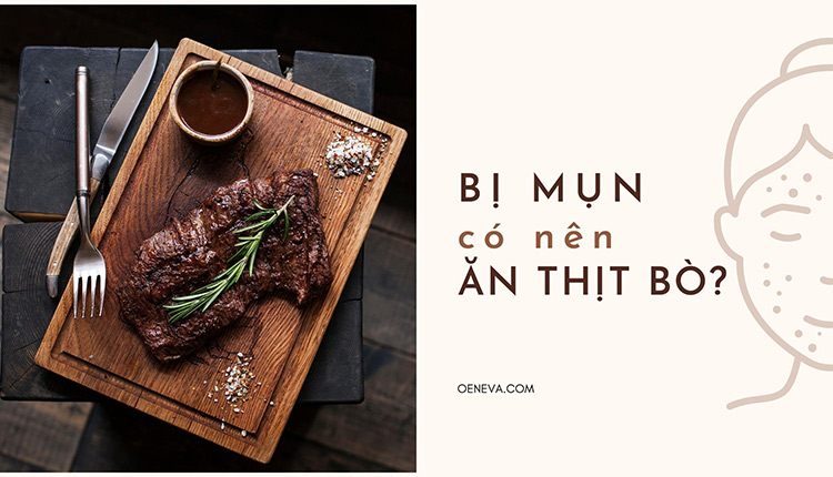 Bị mụn có nên ăn thịt bò không? Nên kiêng ăn gì? 1