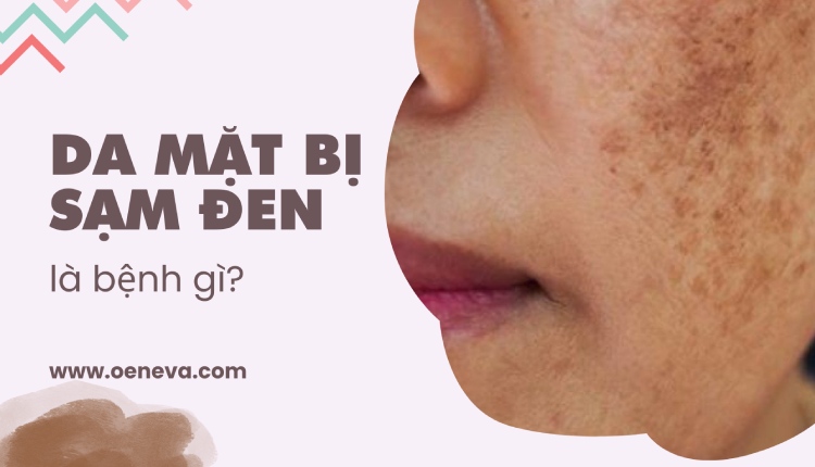 Da mặt bị sạm đen là bệnh gì? Tìm hiểu nguyên nhân gây sạm da 1 Da mặt bị sạm đen là bệnh gì? Tìm hiểu nguyên nhân gây sạm da 1