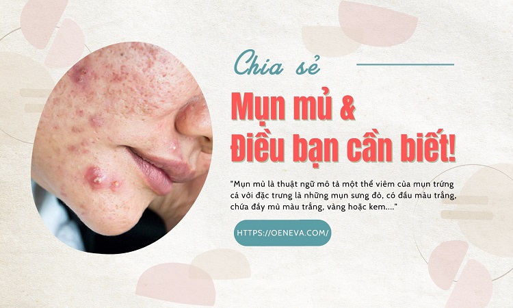 Mụn mủ và những điều bạn cần biết! 1