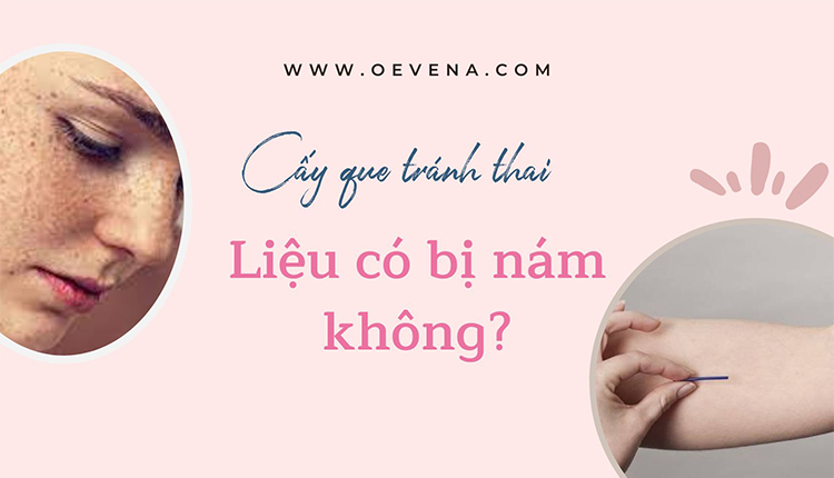 Giải đáp: Cấy que tránh thai có bị nám da không? 1 Giải đáp: Cấy que tránh thai có bị nám da không? 1