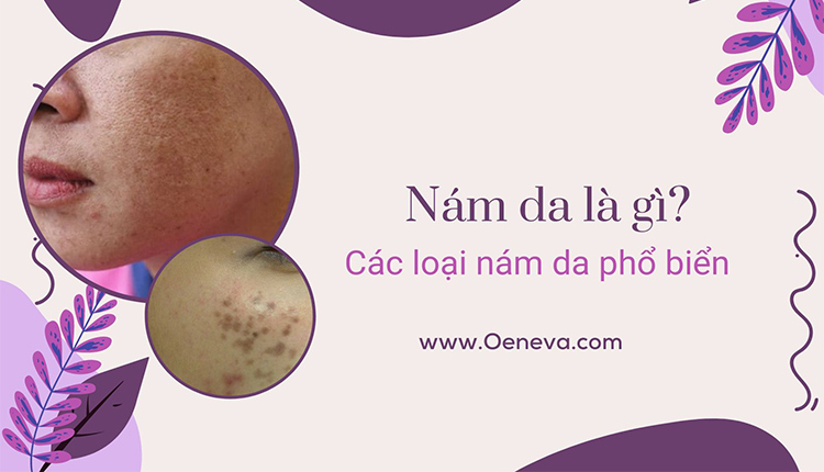 Nám da là gì? Các loại nám da phổ biến 1 Nám da là gì? Các loại nám da phổ biến 1