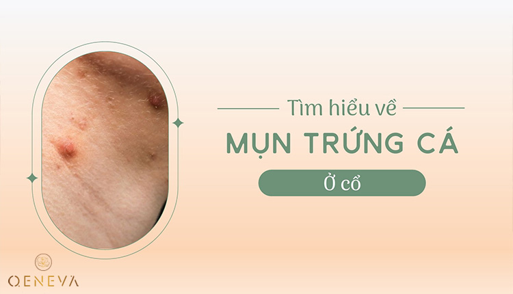 Tìm hiểu về mụn trứng cá ở cổ 1 Tìm hiểu về mụn trứng cá ở cổ 1