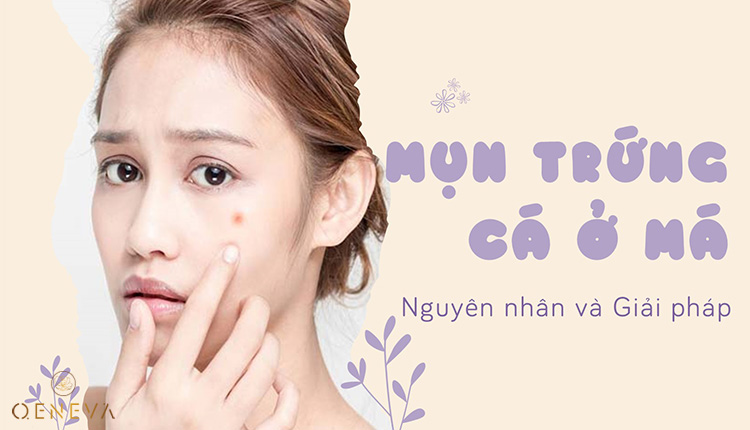 Tìm hiểu về mụn trứng cá ở má: Nguyên nhân và giải pháp