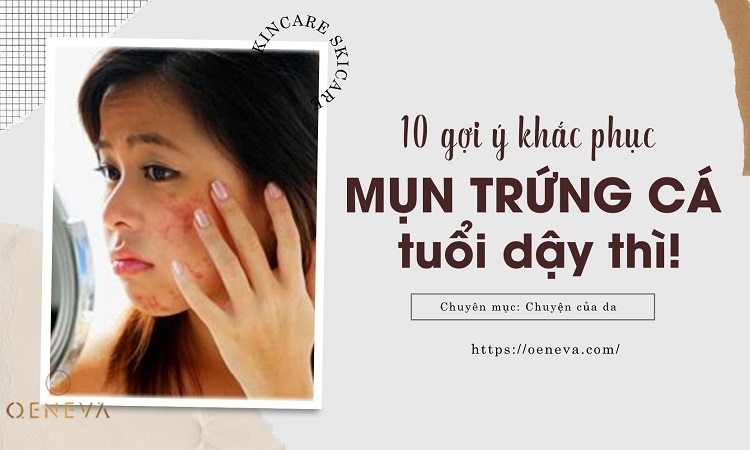 Chuyên gia gợi ý 10 cách kiểm soát mụn tuổi dậy thì 1 Chuyên gia gợi ý 10 cách kiểm soát mụn tuổi dậy thì 1