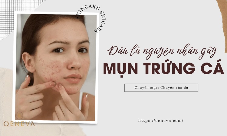 Đâu là nguyên nhân gây mụn trứng cá? 1