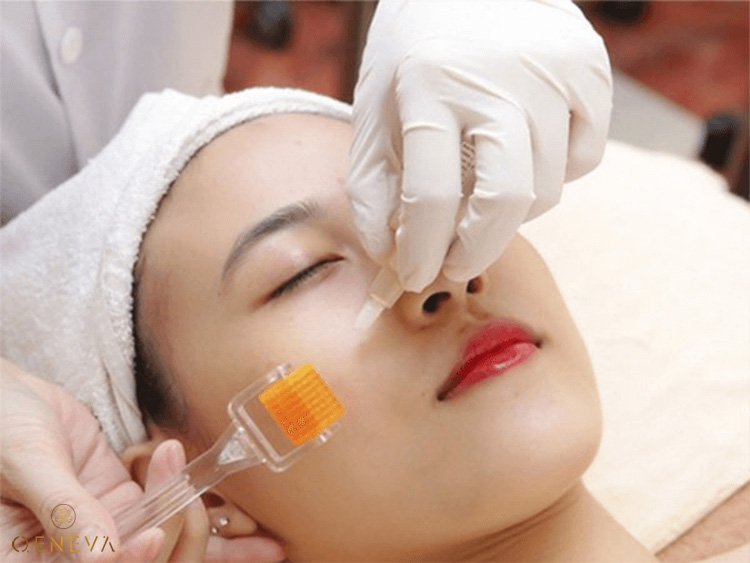 2. Bị mụn ẩn có nên lăn kim không? 1