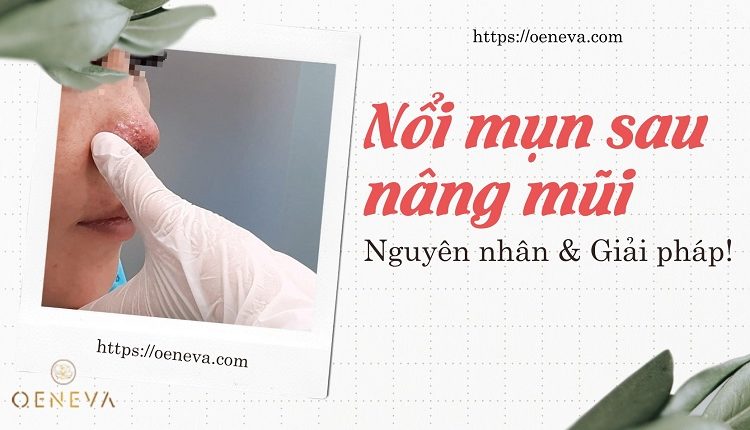 noi-mun-sau-nang-mui