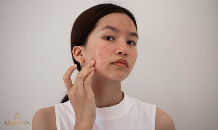 2.3. Xuất hiện mụn trứng cá 1