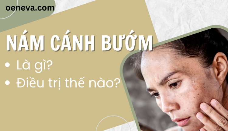 Nám cánh bướm là gì? Gợi ý cách điều trị hiệu quả 1