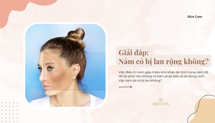 Nám da có bị lan không Nám da có bị lan không